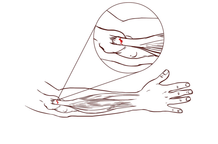Tennis elbow.